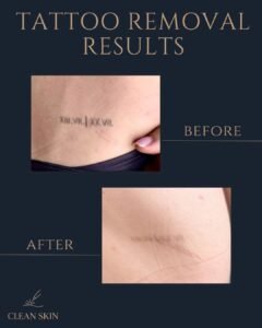 Laser Treatments - hernandez tattoo studio miami6