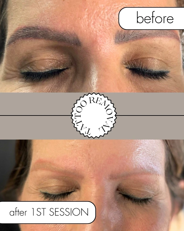laser-treatments AFTER