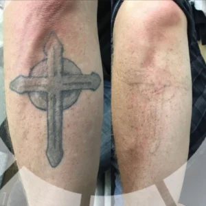 Laser Treatments angie