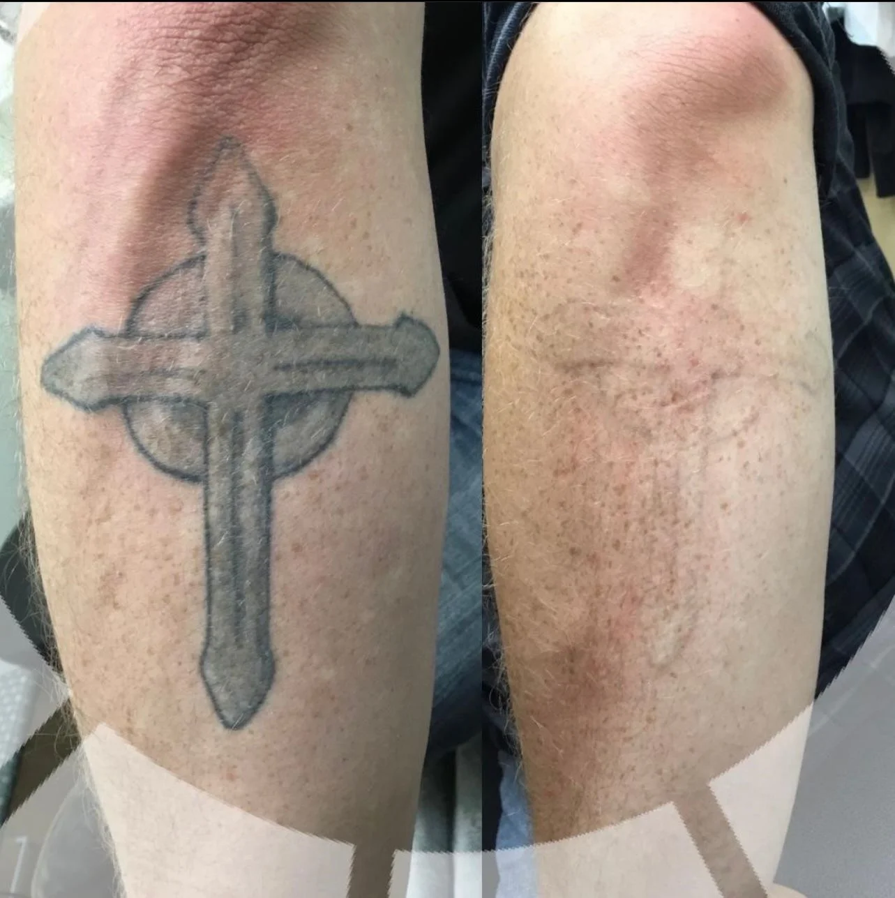 Laser Treatments angie