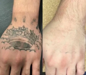 angie cordoba Laser Treatments