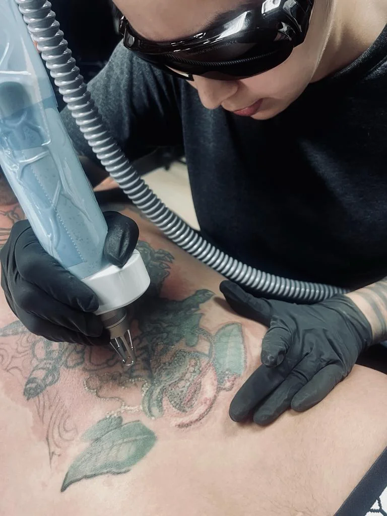 angie cordoba Laser Treatments