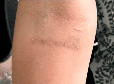 laser-treatments AFTER